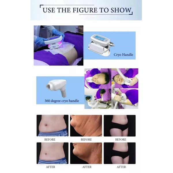 4 Handle Fat Freezing Machine Body Sculpting Coolplas Sincoheren Cryotherapy
