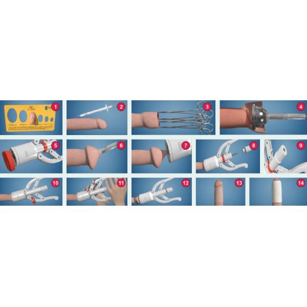 Достоверное аноректальное урологическое хирургическое оборудование одноразовое обрезание набор сцепщик для взрослых устройство