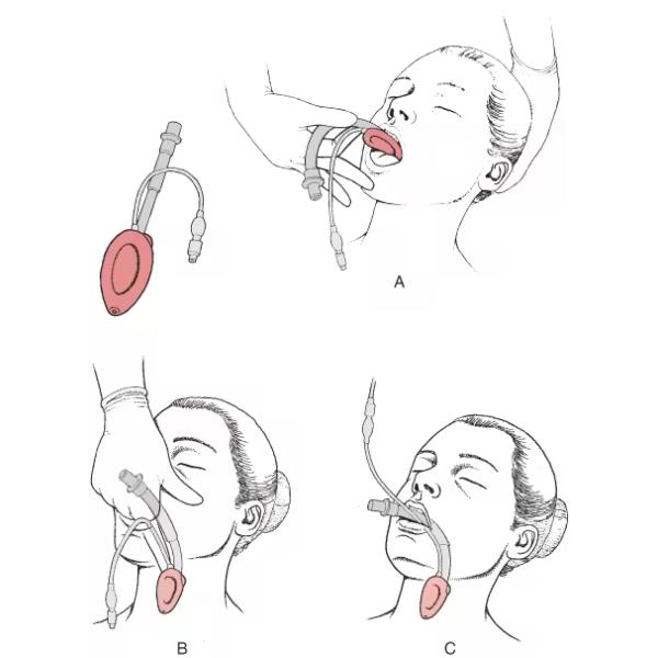 Mayorista de vía aérea con mascarilla laríngea de silicona médica no tóxica, intubada, desechable y ecológica