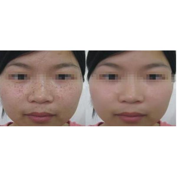 Home Portable Skin Rejuvenation SHR Hair Removal Machine 1-5 Hz Frequency