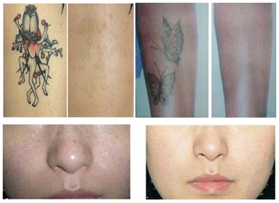 Двойная машина лазера Нд Яг штанги для тарифа повторения ИМПа ульс удаления 1-6Хз татуировки