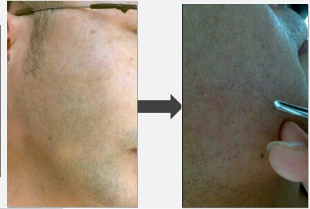 Semiconductor 808 Diode Laser Hair Removal Machine With CE Approved