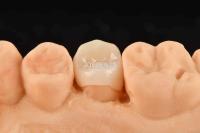 Customizable White Composite Inlay Onlay Natural Looking Minimally Invasive Tooth Restoration