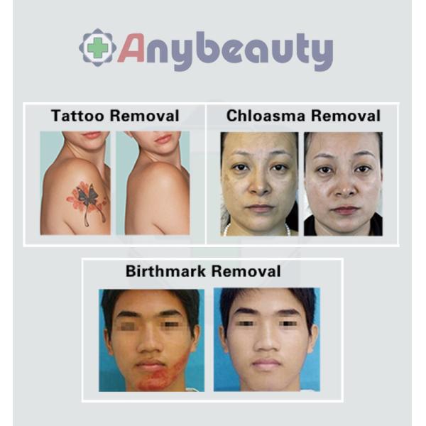 pico laser for tattoo removal Adjustable Spot Picosecond Laser Tattoo Removal Device For Pigment Skin Treatment