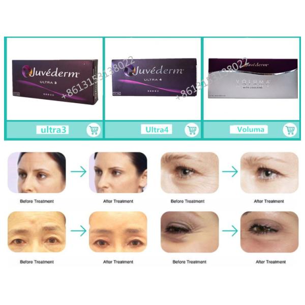 La cruz inyectable del llenador del labio de la ha Juvederm Voluma ligó las jeringuillas ácidas hialurónicas