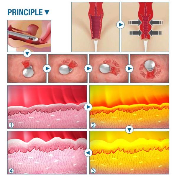 100% Pure Imported USA RF Tube Co2 Fractional Laser Machine Vaginal Tightening
