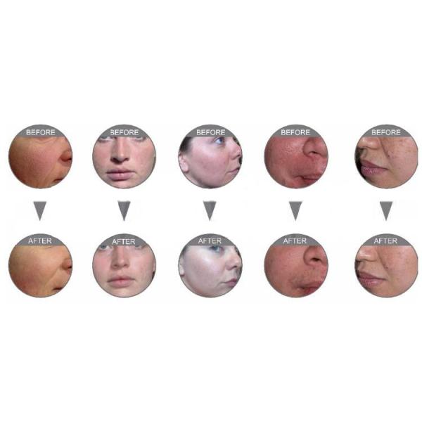 5 Handles Facial Oxygen Jet Peel Beauty Equipment Facial Oxygen Therapy Machine