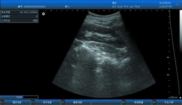 3D Digital Laptop Portable Ultrasound Scanner With All Kinds of Probe