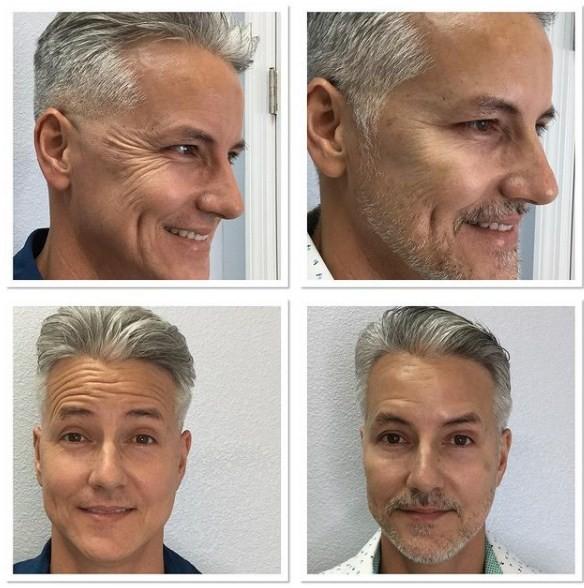 Wrinkles Removal Powder  Botulinum Toxin OEM 100 Units