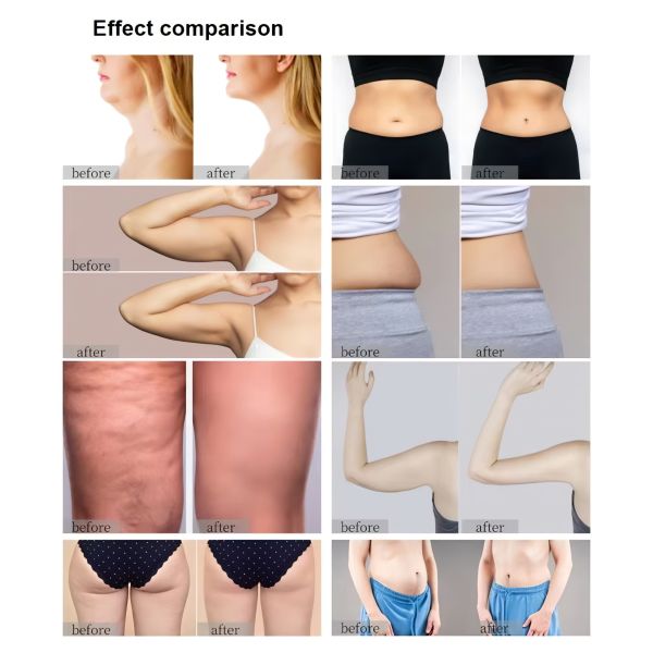 Microwave Fat Reduction Machine 2.45GHz 600W Skin Tightening Machine For Body Sculpting