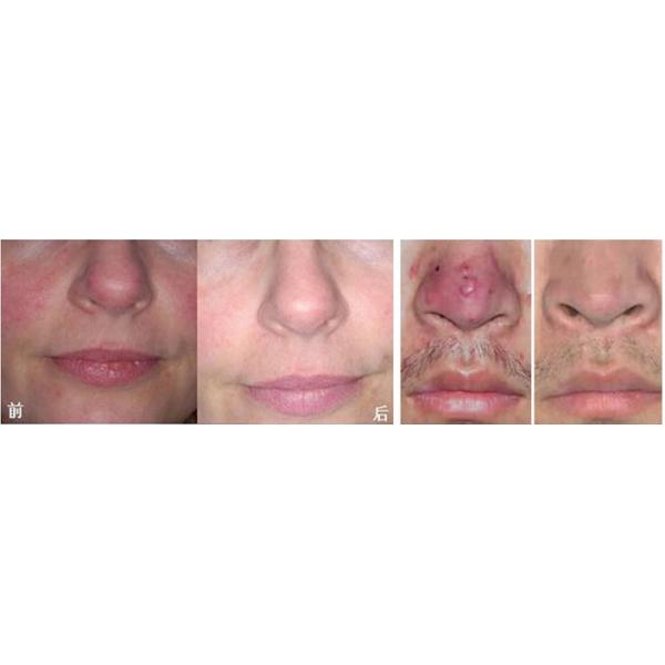 Portable Medical Spider Vein Diode Laser Vascular Removal Machine 980nm Professional