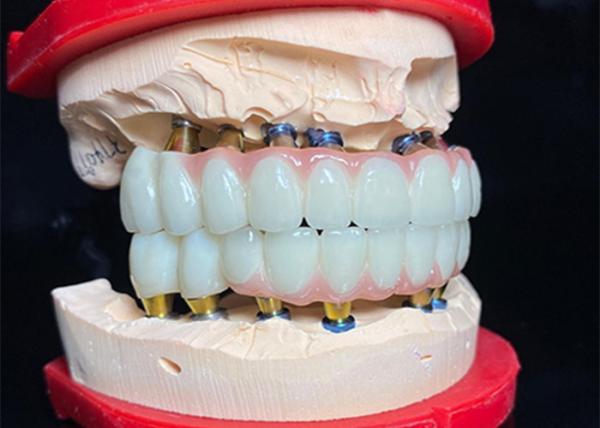 Polished Titanium Base dental Implant Ceramic Crown Bridge For Dental Restoration