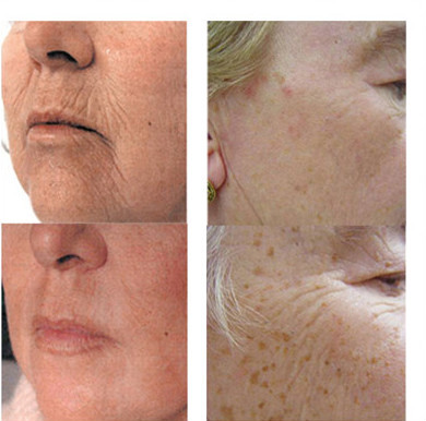 Factory Multifunctional Medical laser hair reomva SHR+OPT+Elight+ RF +Laser beauty IPL shr