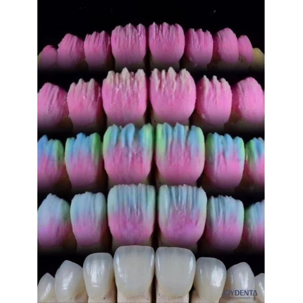The Joydenta Ceramic Veneer Process