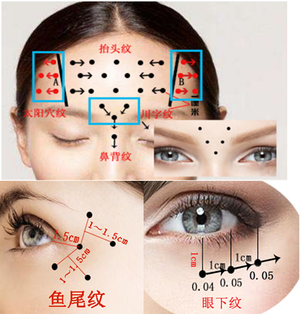 Впрыски блоков токсина 100 Hyamely Botox токсин заполнителя морщинки Botulax Botulinum анти-