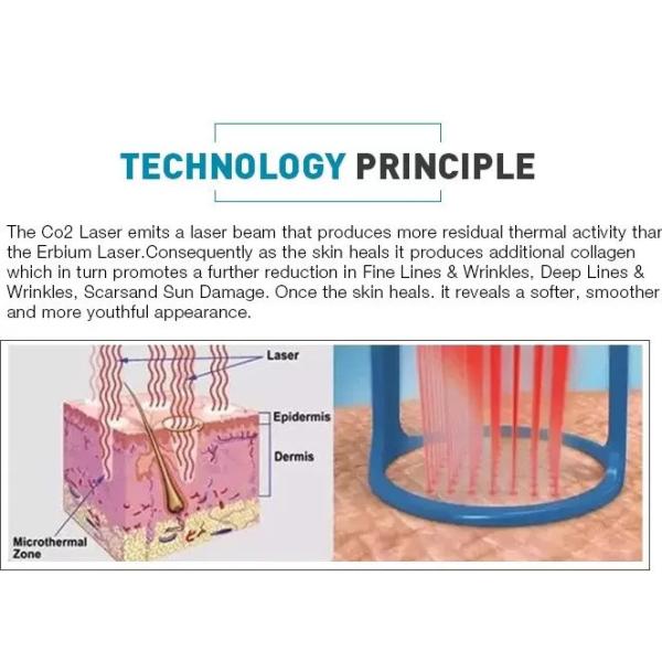 Continuous Interval Ultra Pulse RF Fractional CO2 Laser For Fractional Skin Resurfacing