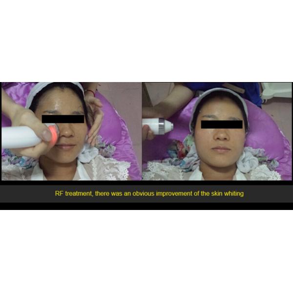 Professional SHR Hair Removal Machine