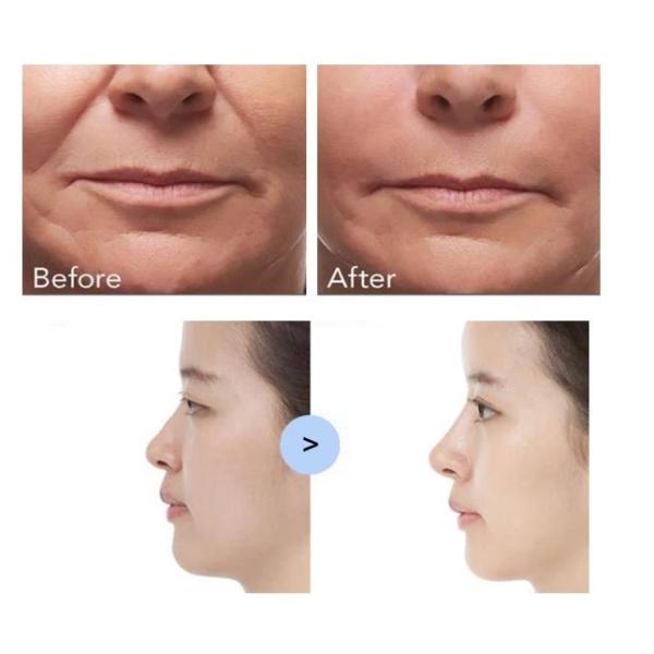 High Press Hyaluron Filler Pen Ha Pen Lip Filler Кожный наполнитель 0,5 кг