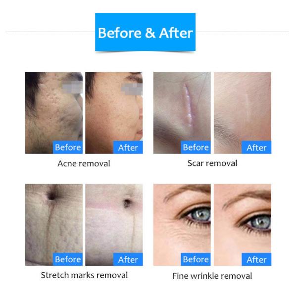 Портативная машинка Microneedle Rf сыворотки Cryo машины RF Microneedling добродетеля A6s частичная