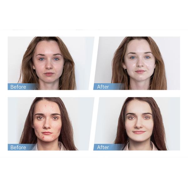 Home Spa Facial Microneedle Therapy Machine With Auto Stop Overheating Protection