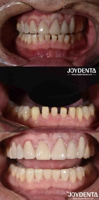 Forme naturelle Porcelaine cosmétique Dentisterie Porcelaine dentistique Porcelaine cosmétique
