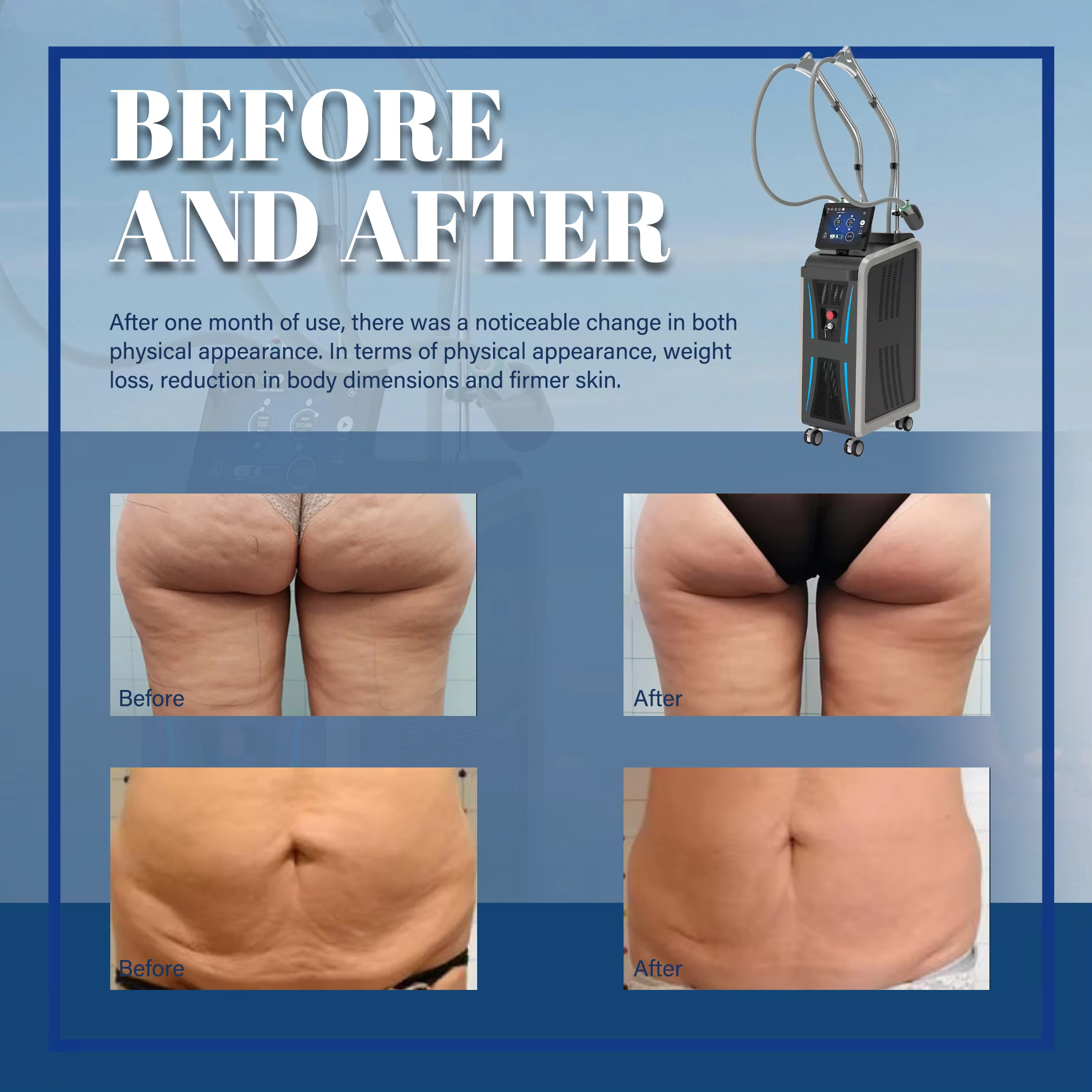 Coolwaves 3 Handles Targeted Fat Loss Cellulite Improvement RF Cryo Ice Microwave Device