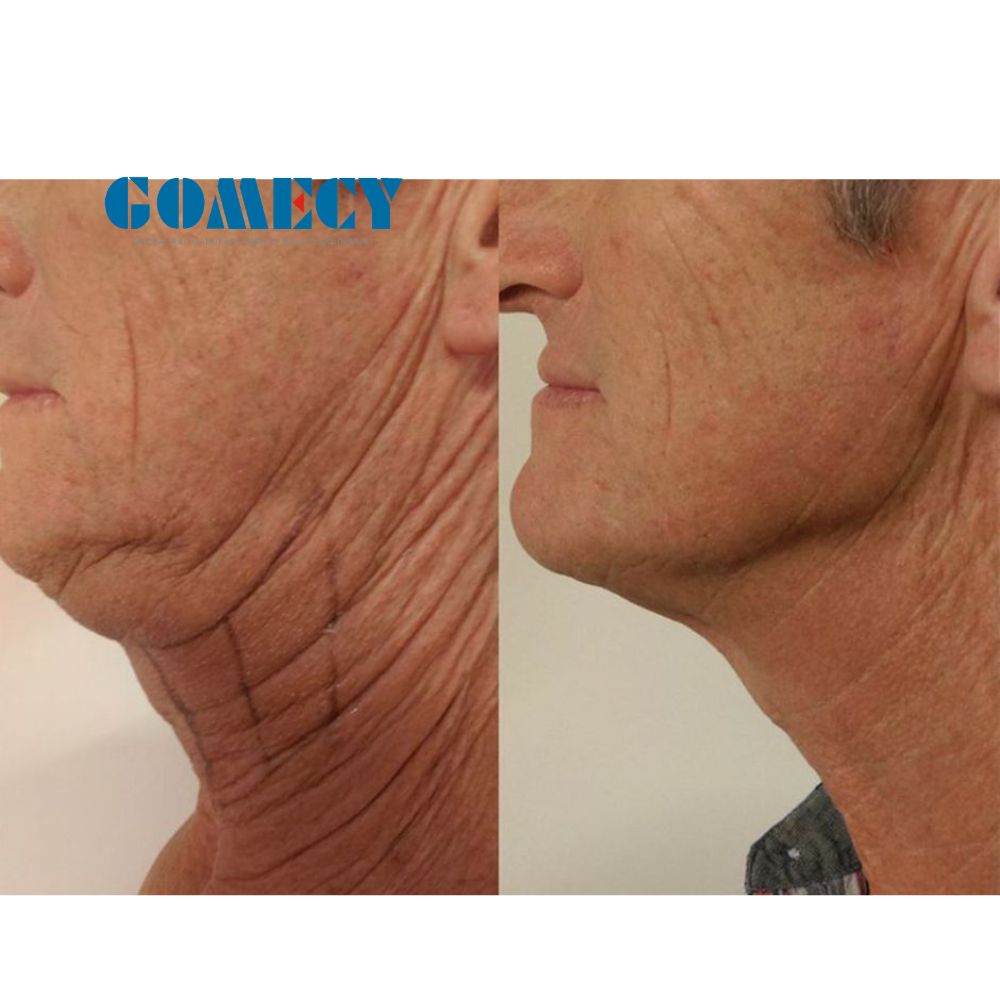 Super Quality Thermal RF Ultralift Titanium Equipment for Skin Firming Body Contouring and Post Pregnancy Restoration