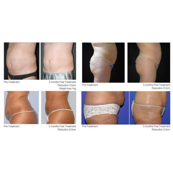 Rf Roller Massage Vacuum Slimming Machine , Ultrasonic Vacuum Cavitation Machine