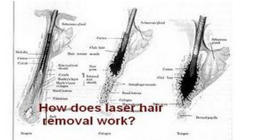 808nm Diode Laser Hair Removal Machine Powerful Germany Emitter 0.5~10HZ