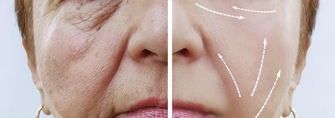 1,1 Revolax Ml кислоты заполнителя Hyaluronic дермальной для губ