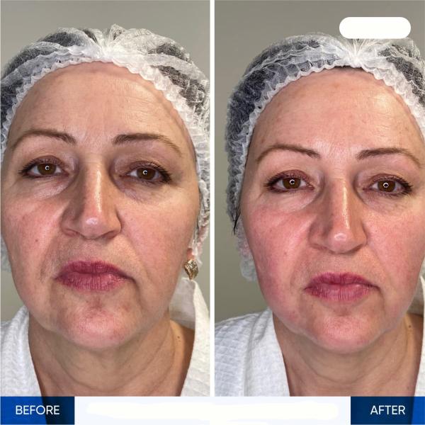 Máquina Ultra III 7D HIFU para el levantamiento por ultrasonido, apretamiento y contorno