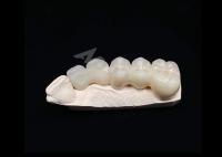 Translucidez Estética natural Coroa de zircônio sólido para dentes Resistente a quebra