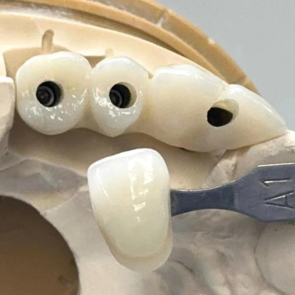 Porcelaine Zirconia Ciment Implanté à vis retenue Forme de tête hexagonale pour une esthétique personnalisée