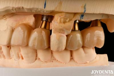 Restauration des dents manquantes Implantation couronne et pont sans danger pour l'oral avec un ajustement précis