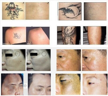 Омолаживание кожи E Light Laser IPL Machine Equipment 2 в 1 Лечение прыщей