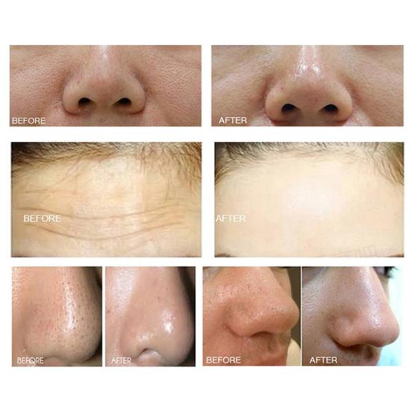 7in1 Hydro Facial Machine With Mask Wrinkle Removal Diamond Peeling