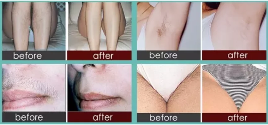 mini 808nm hair removal home use easy to operate, no pain hair removal permanently