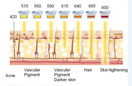 IPL hair removal,skin rejuvenation device,pigment removal equipment
