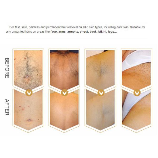 Three Wavelength Laser Body Hair Removal Machine 10-120j / Cm2 Fluence 1200W
