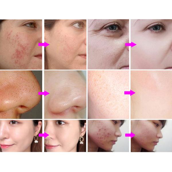 Hottest Korean 14in1 Hydro Microdermbrasion Hydra Oxigen Facial Machine 2023