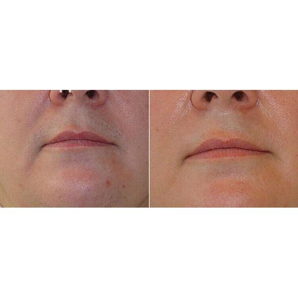 CE approval 70J/c㎡ 808 nm skin rejuveantion diode laser hair removal machine