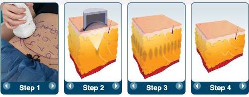 4MHz Hifu Body Slimming Machine , Beauty Salon Equipment High Intensive Ultrasoic