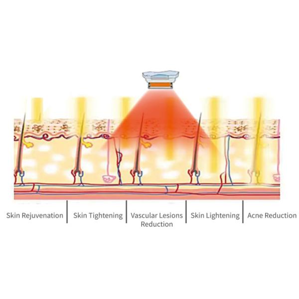 Eliminación de vello Rejuvenecimiento de la piel SHR IPL máquina de belleza 2000W con 2 asas