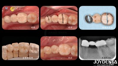 Tailored Dental Zirconia Crown Biocompatibility Comfort Customization For Optimal Patient Experience