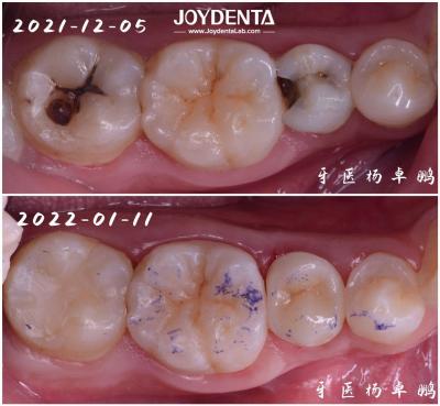 High Durability Inlay Dental Restoration For Damaged Tooth Various Sizes Available