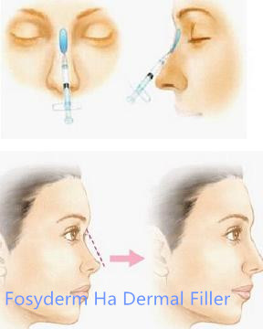 Заполнитель носа впрыски Хялуроник кислоты дермальный, заполнители геля Хялуроник кислоты