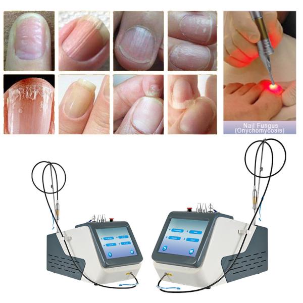 Лазер диода 980nm класса IV для терапии Onychomycosis