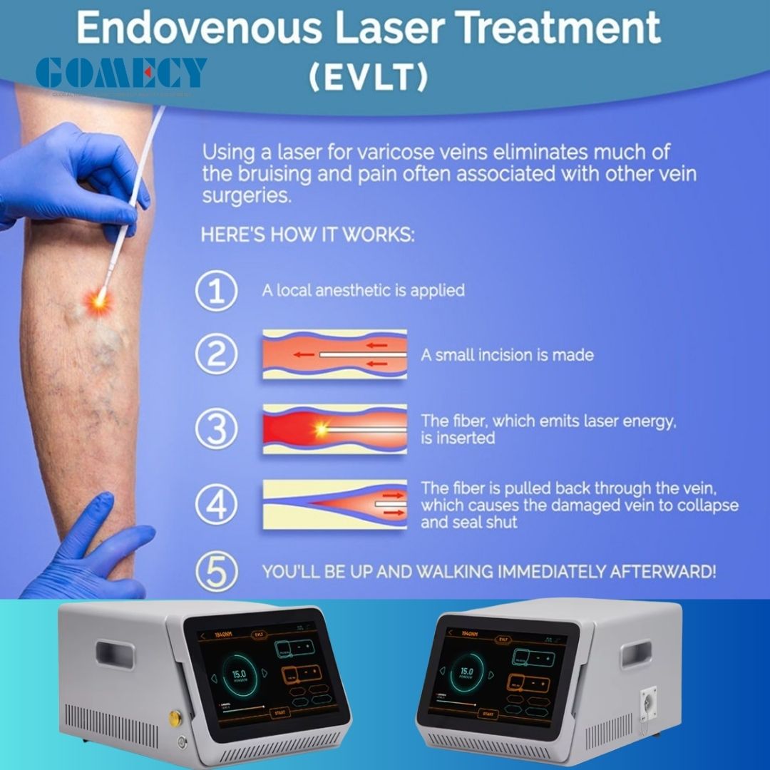 1940nm Diode Laser For Varicose Vein Removal Varicose Veins Laser Machine EVLT 1940 Varicose Veins Laser Treatment