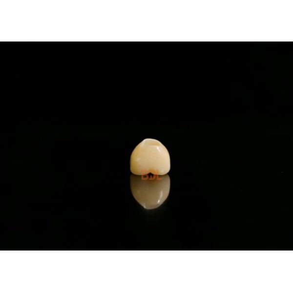 Digital Dental Implant Bar with Customized Scan Body All Ceramic Crown and Wax Pattern for Full Process Implant Restoration Control