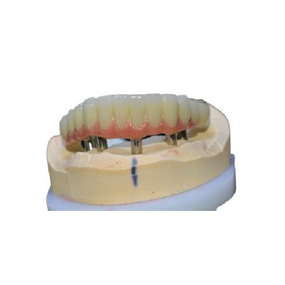 Coroa de limpeza fácil do implante dental confortável nenhuma sensação do corpo estrangeiro